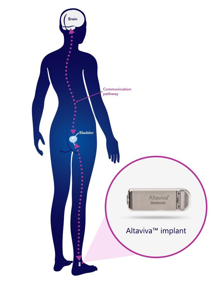 Altaviva implant